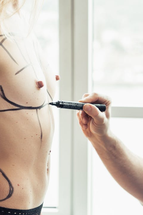 Dessins lors d'une consultation d'un Lipofilling mammaire : augmenter la taille du sein sans implant par le Dr. Alexandre Mertens