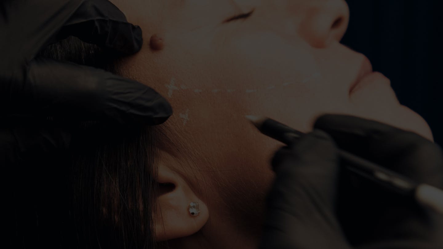 La pose des fils tenseurs par le Dr. Alexandre Mertens