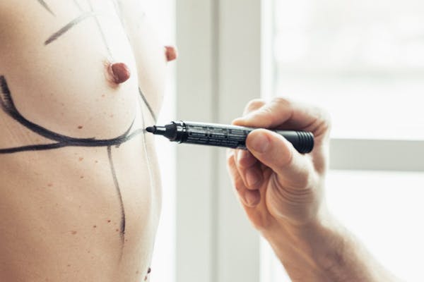 Lipofilling mammaire