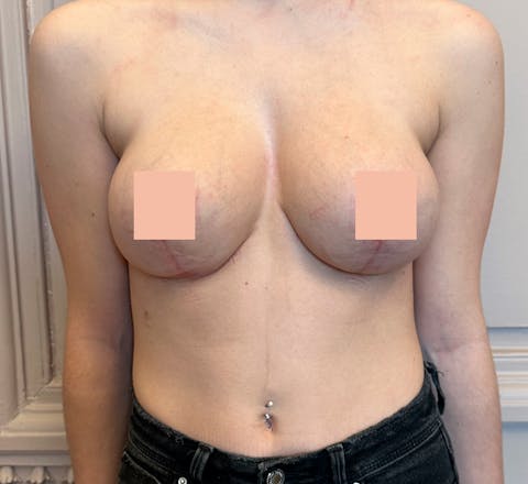 Aprés Réduction mammaire