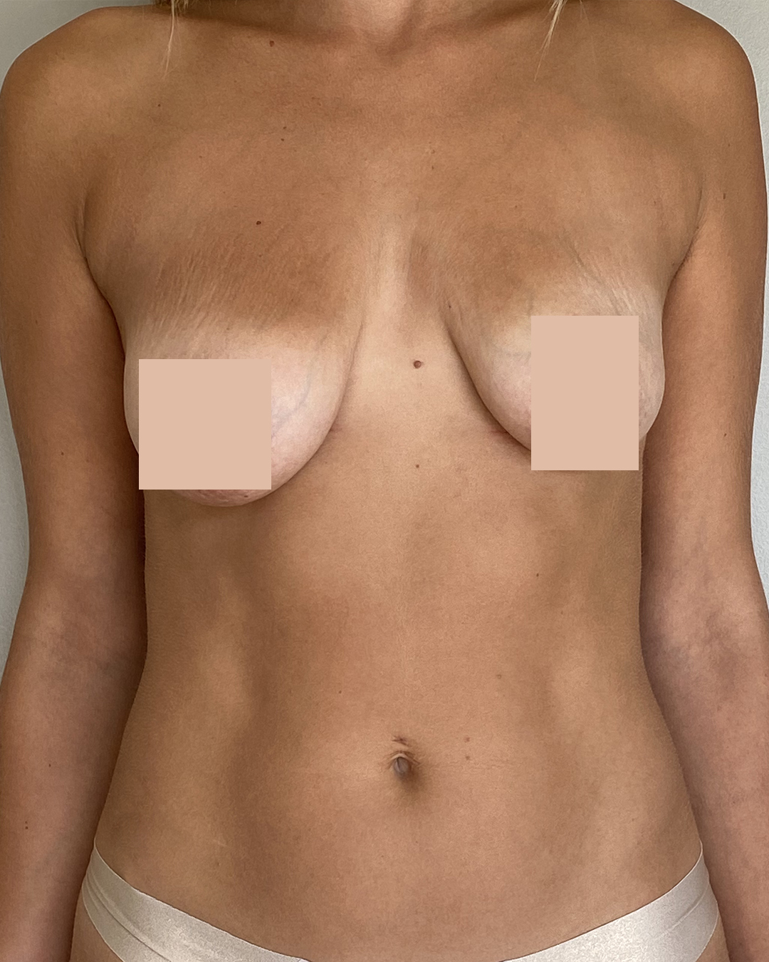 Avant Augmentation Mammaire & lifting des seins