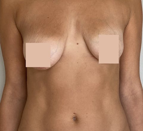 Avant Augmentation Mammaire & lifting des seins