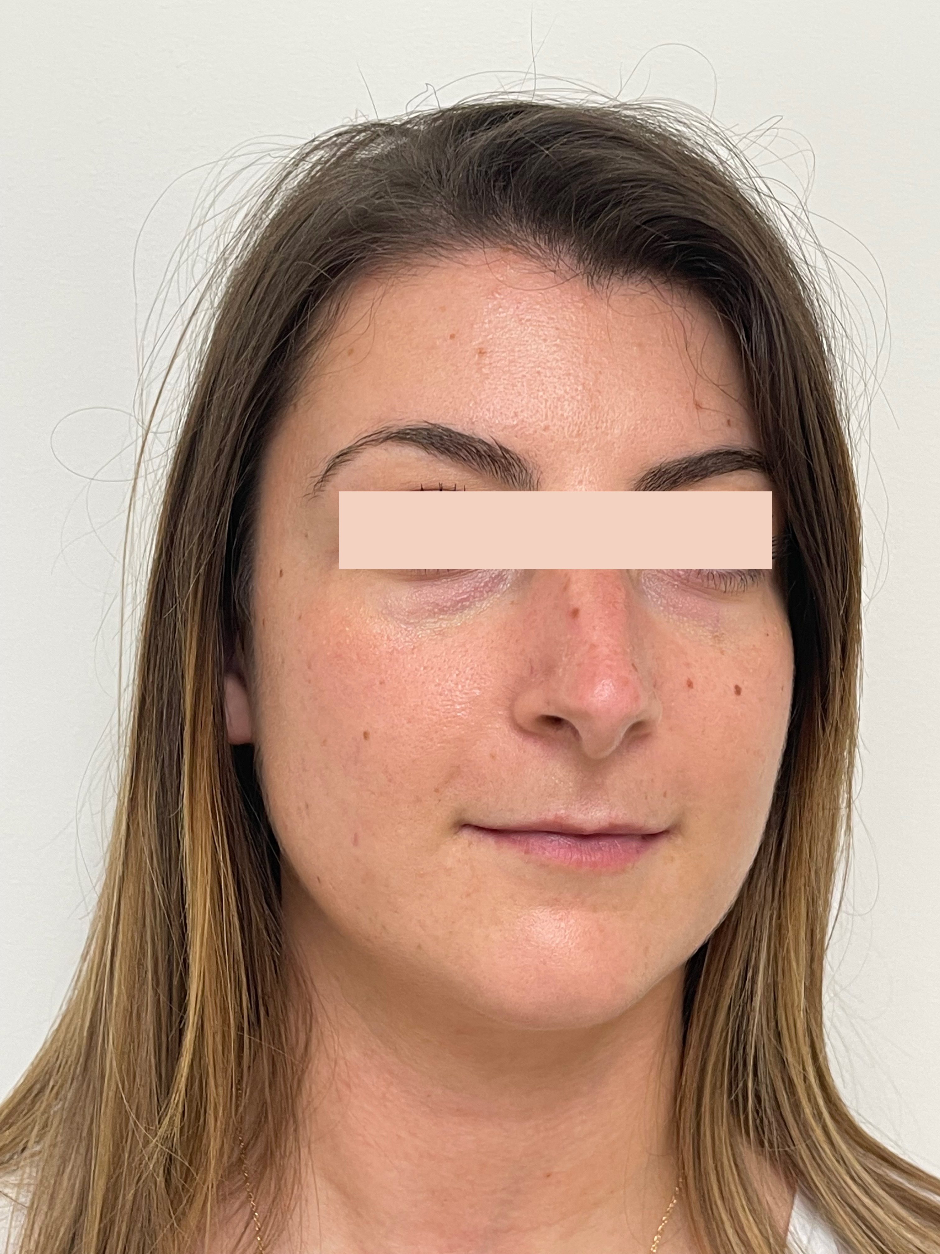 Avant Acide hyaluronique dans les cernes