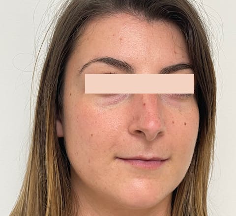 Avant Acide hyaluronique dans les cernes