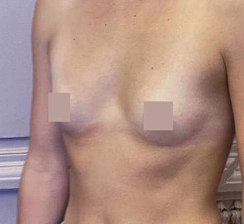 L’augmentation mammaire par prothèses moyennes avant