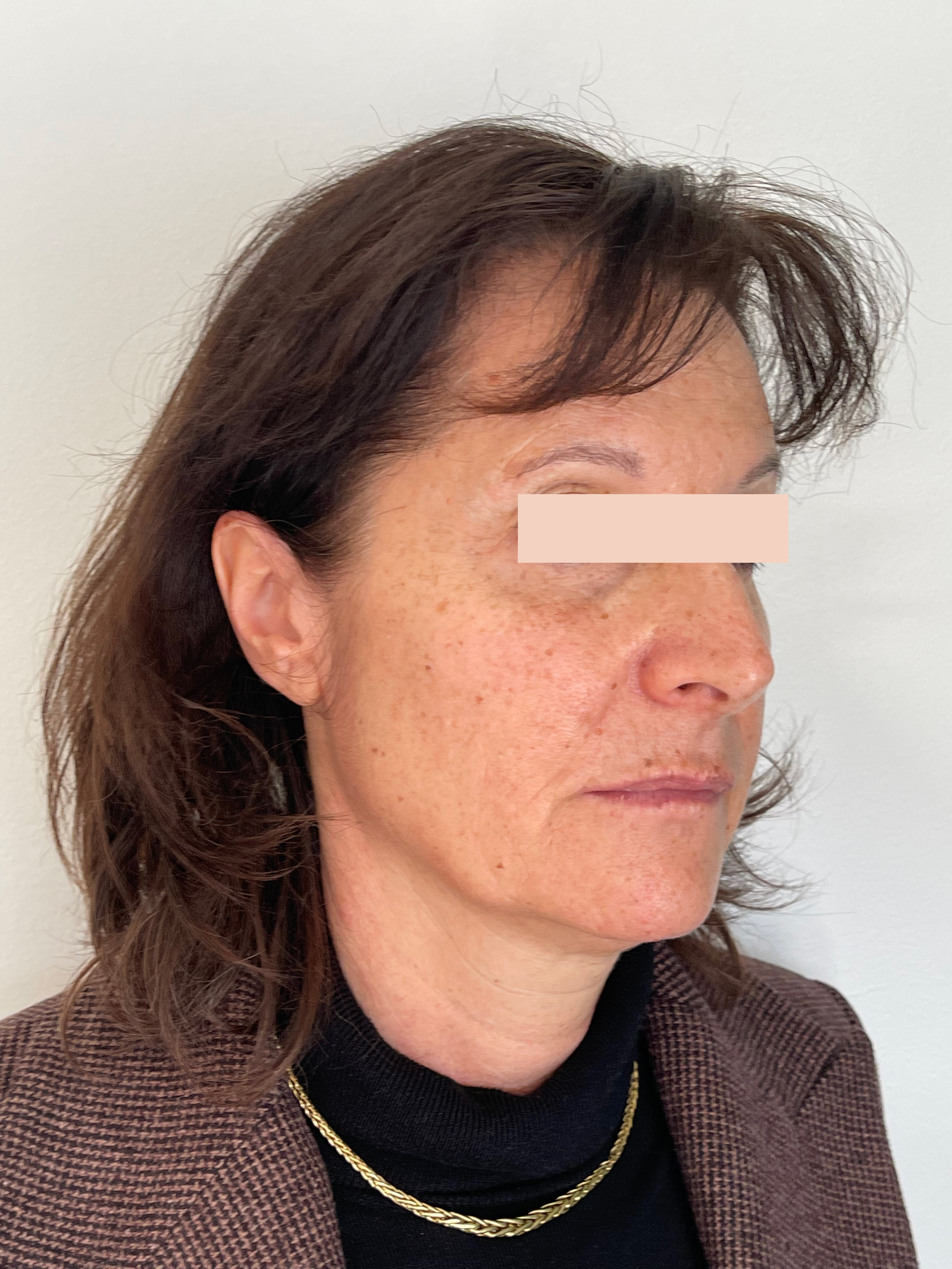 Après Fils tenseurs