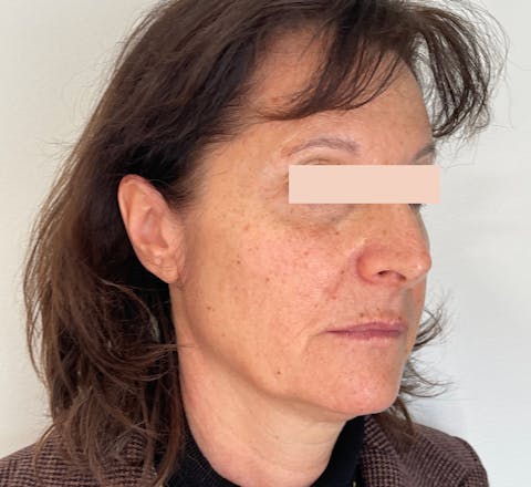 Après Fils tenseurs