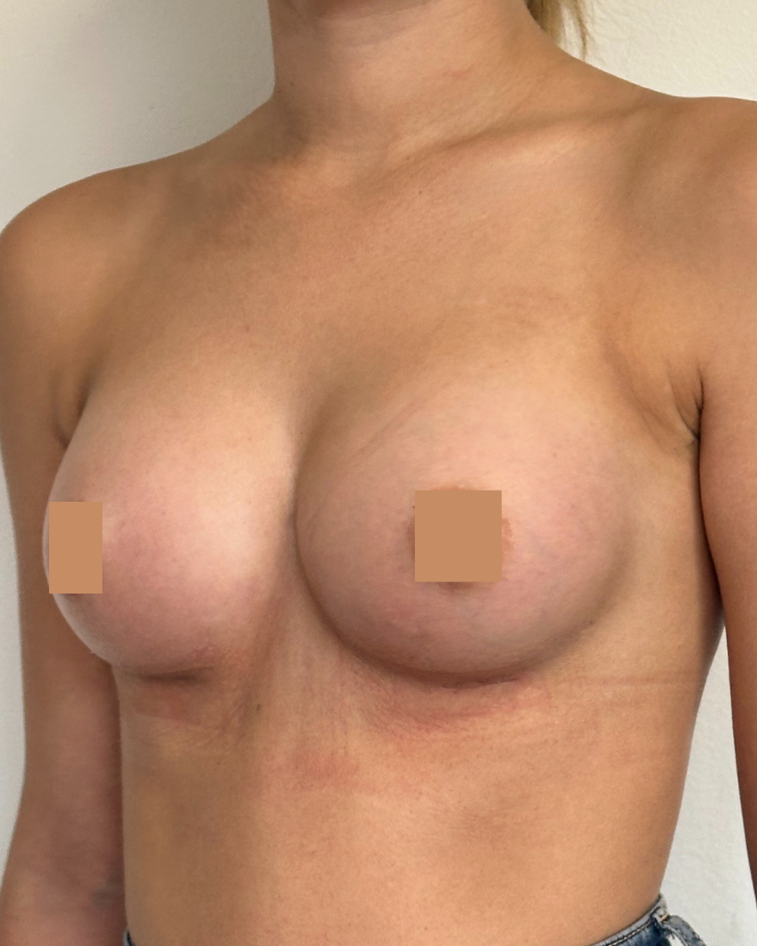 après augmentation mammaire lyon