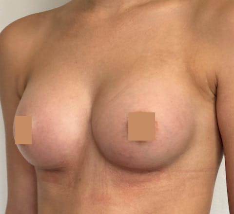 après augmentation mammaire lyon