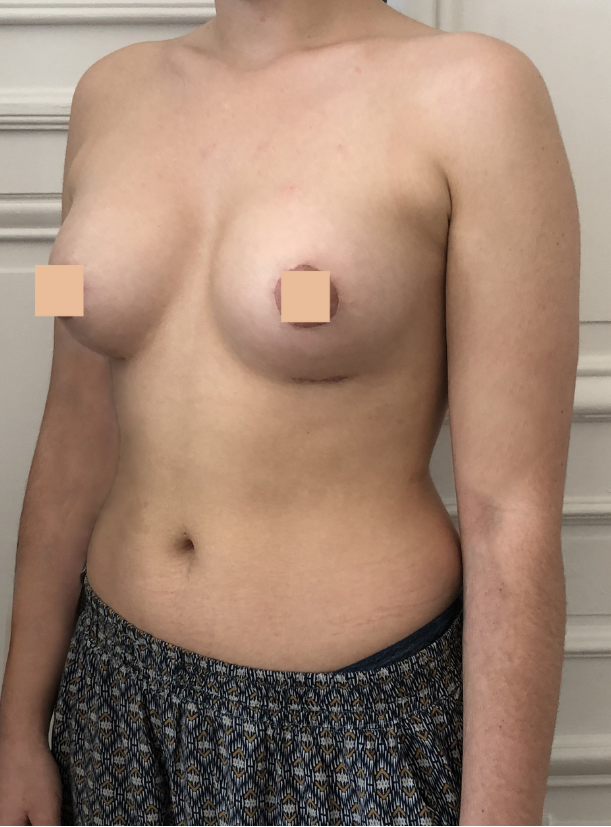 sein tubéreux après correction