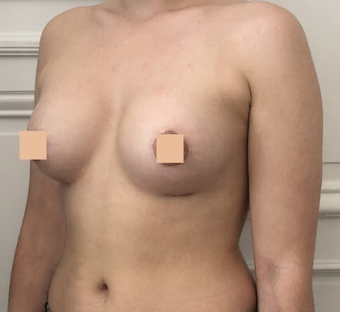 sein tubéreux après correction