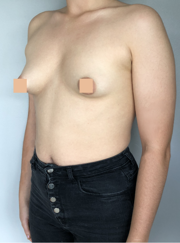 seins tubéreux avant correction