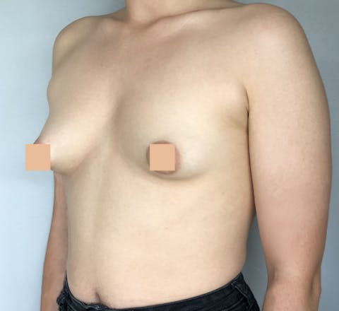 seins tubéreux avant correction