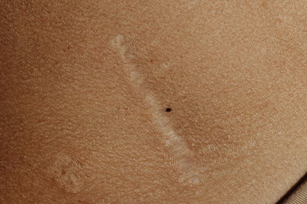 La gestion des cicatrices suite à une réduction mammaire : l'arrêt du tabac, ne pas exposer les cicatrices au soleil, privilégier une alimentation équilibrée.