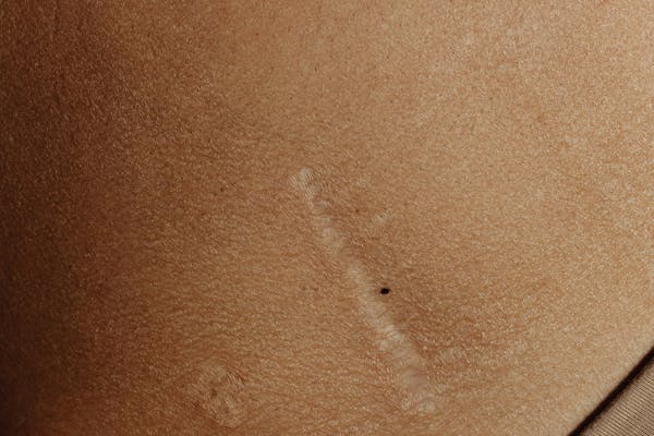 Cicatrice peau