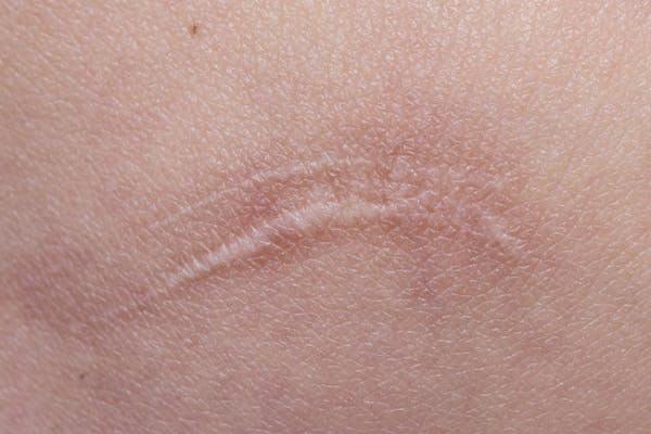 cicatrice augmentation mammaire