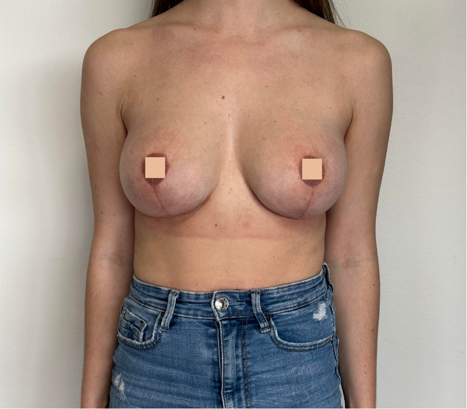 avant apres correction augmentation mammaire ratee lyon