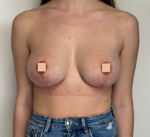 avant apres correction augmentation mammaire ratee lyon