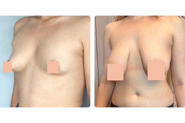 malformation mammaire : seins tubéreux, petit et forte poitrine