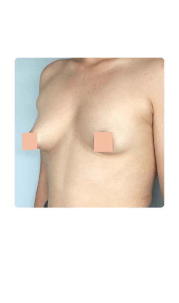 seins tubéreux avant opération chirurgicale