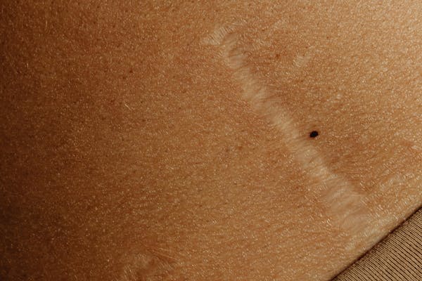 Cicatrice sur la peau d'une jeune femme pour illustrer la protection d'une cicatrice.