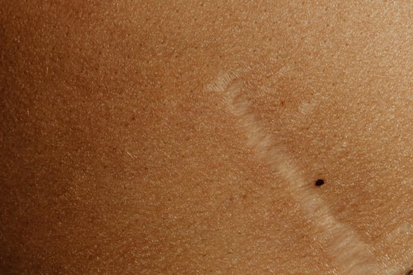 Focus sur cicatrice après lifting mammaire.