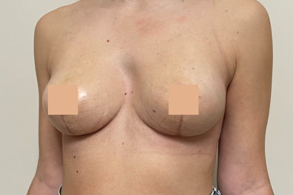 Seins d'une jeune femme après un lifting mammaire avec un focus sur les cicatrices.