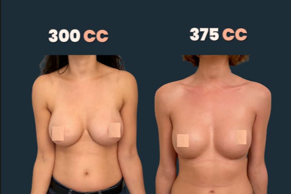 avant apres augmentation mammaire lyon vienne dr mertens