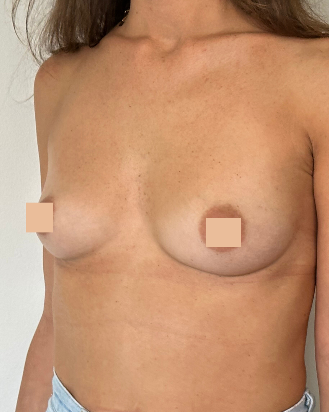 Avant apres pose de protheses mammaires Augmentation mammaire par implants 