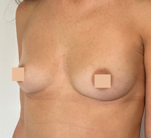 Avant apres pose de protheses mammaires Augmentation mammaire par implants