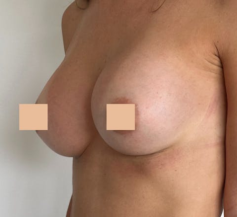 Avant apres pose de protheses mammaires Augmentation mammaire par implants