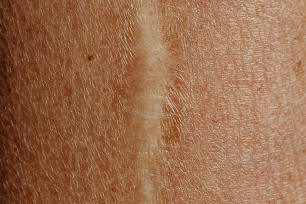 Les cicatrices après une augmentation mammaire.