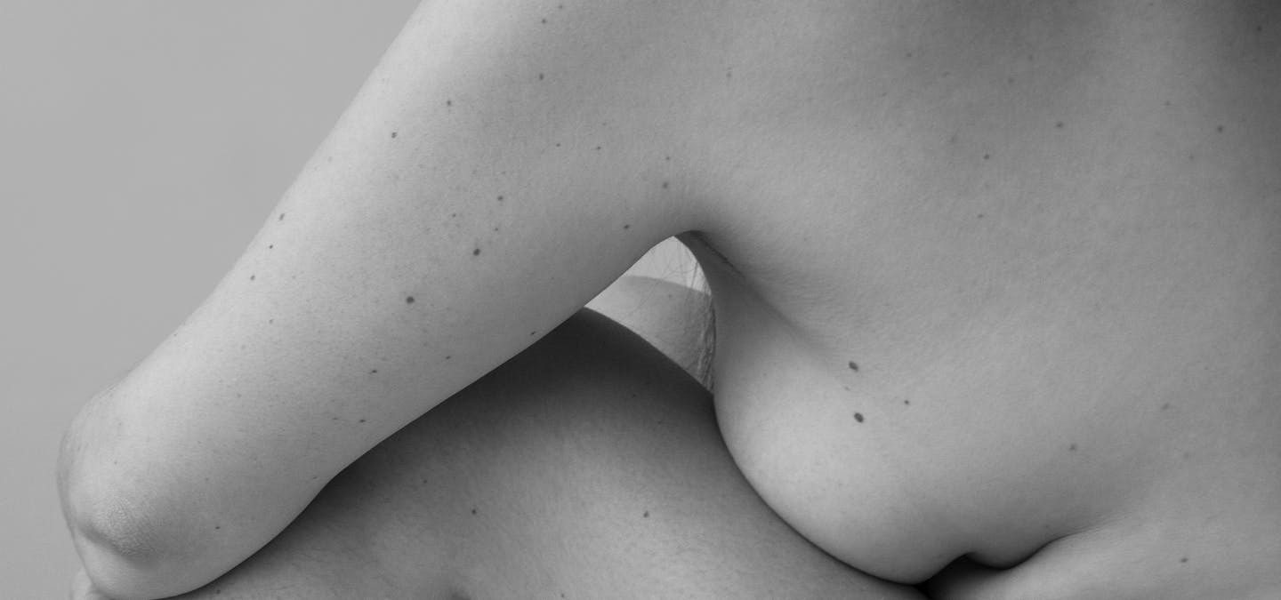 Augmentation mammaire Lyon : faut-il ajouter un lifting et donc des cicatrices ?