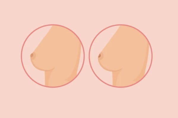 Mamelon invaginé, ombiliqué