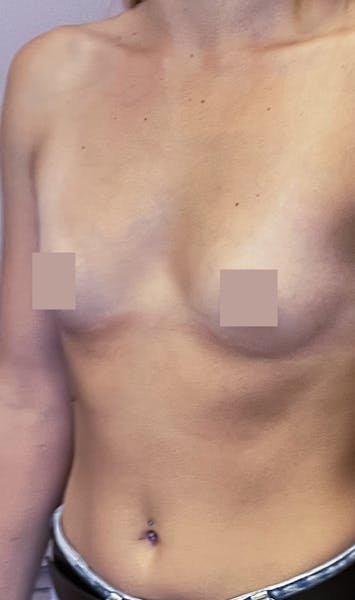 Avant apres augmentation mammaire dr mertens lyon vienne