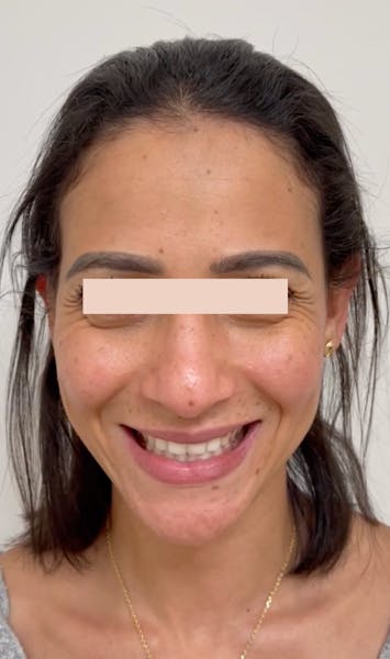 Avant injections de botox au niveau des rides de la patte d'oie