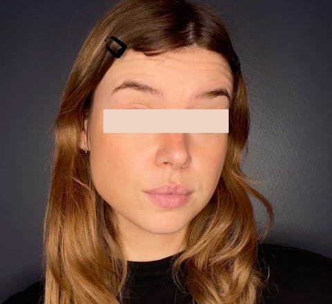 Avant Injections de toxine botulique