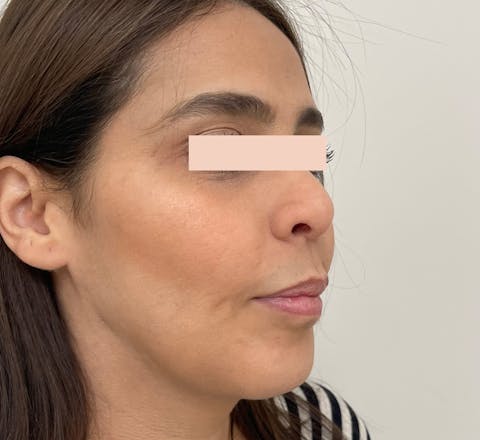 Après Lifting médical par acide hyaluronique