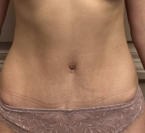 Après mini lift du ventre