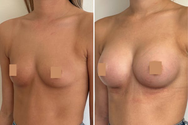 Augmentation mammaire lyon