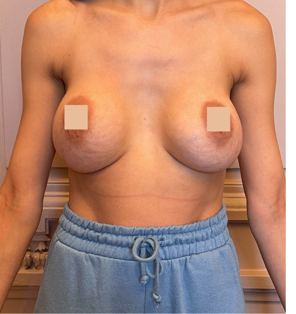 avant changement de prothèse mammaire suite à une augmentation mammaire lyon