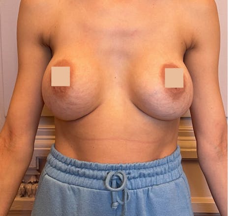 avant changement de prothèse mammaire suite à une augmentation mammaire lyon