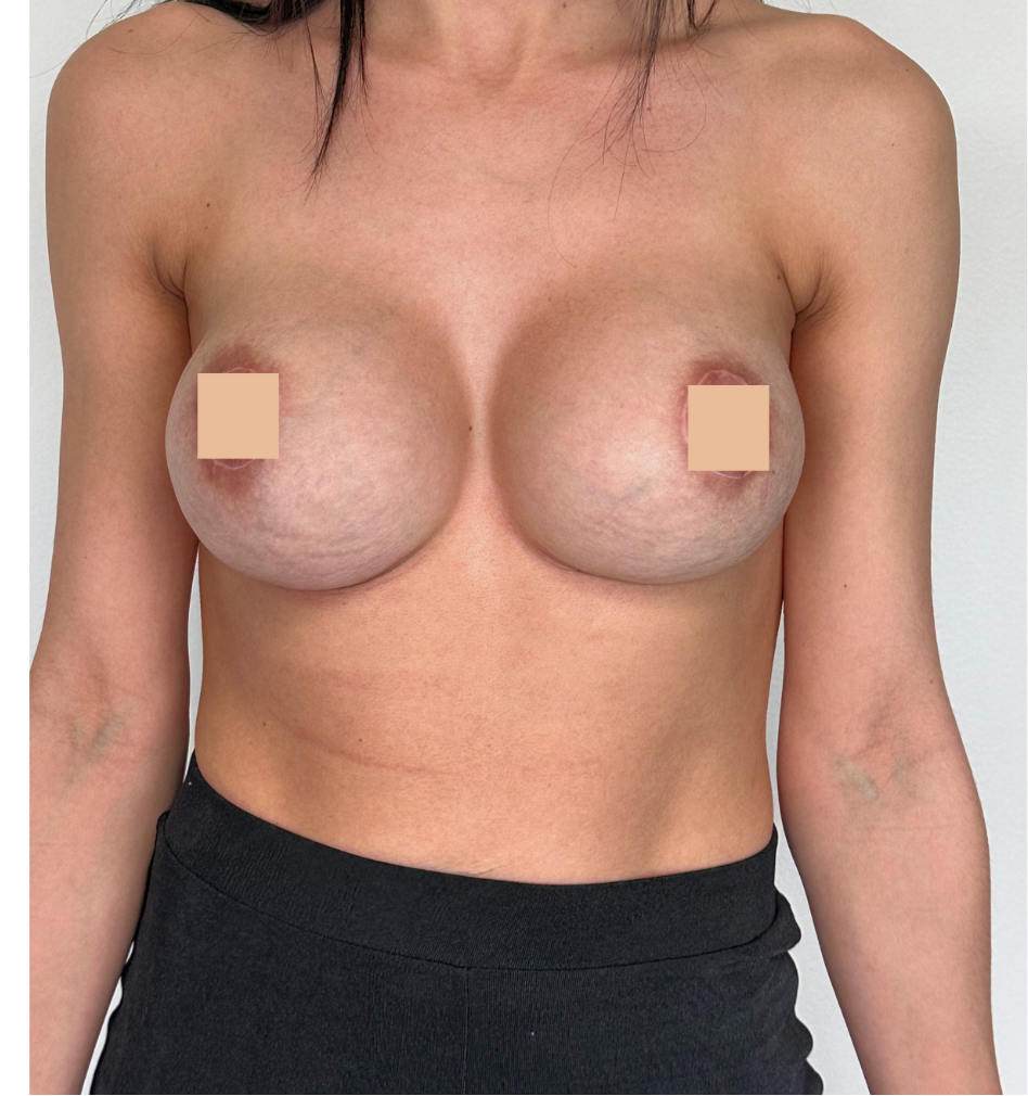 après changement de prothèse mammaire suite à une augmentation mammaire lyon