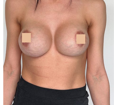 après changement de prothèse mammaire suite à une augmentation mammaire lyon