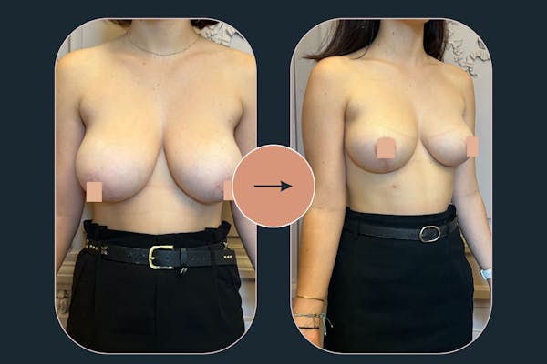 Réduction mammaire lyon : correction hypertrophie mammaire