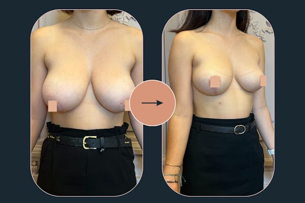 Réduction mammaire lyon : correction hypertrophie mammaire