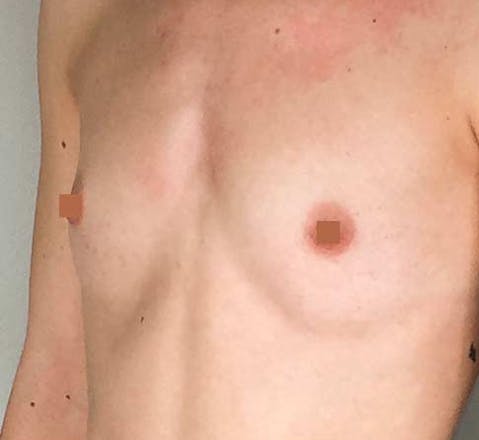 avant aplasie mammaire lyon