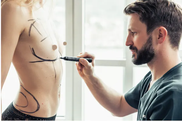 augmentation mammaire par voie sous-mammaire | Dr. Mertens