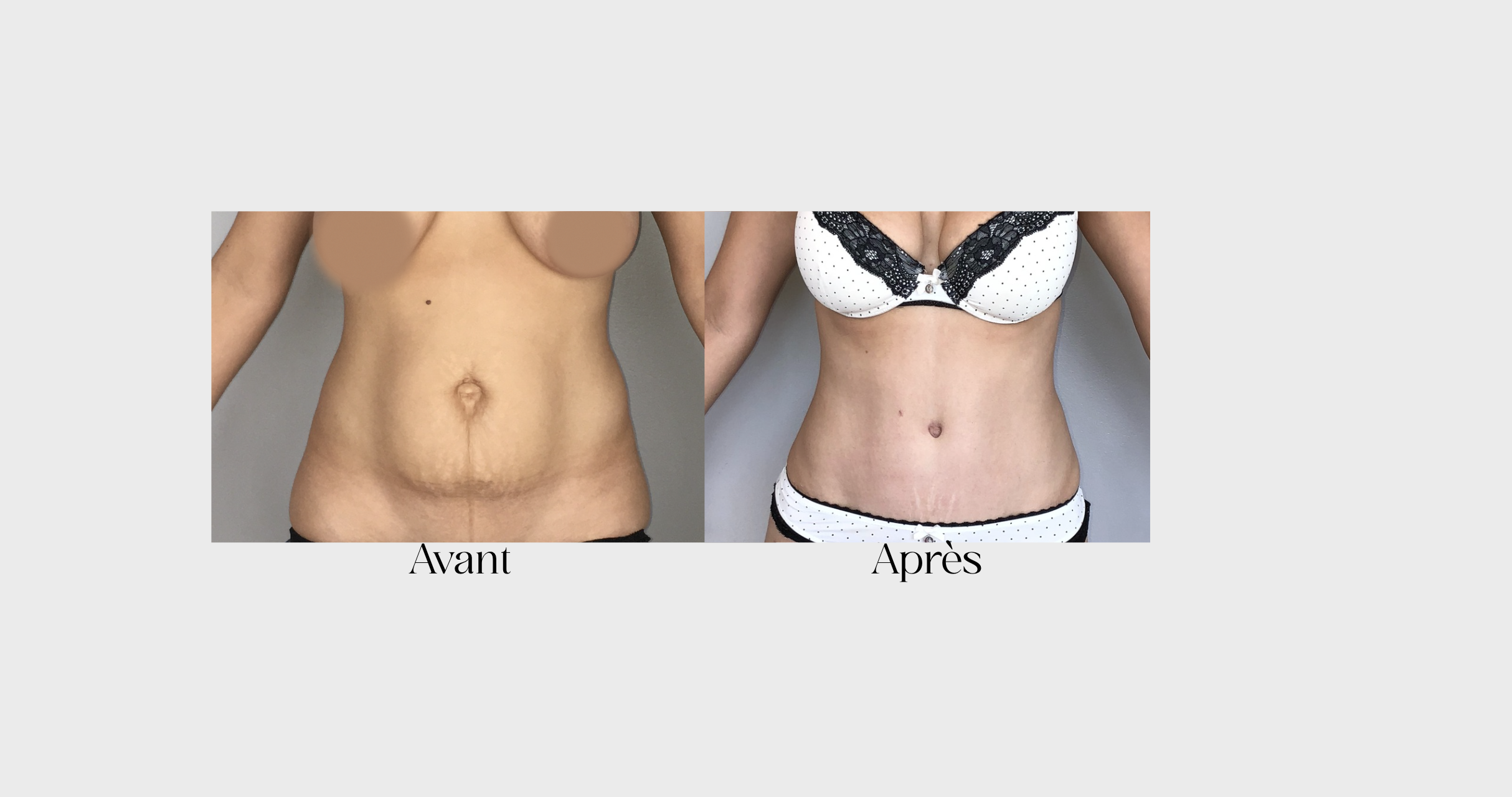 résultat abdominoplastie