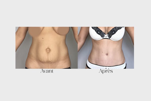 résultat abdominoplastie